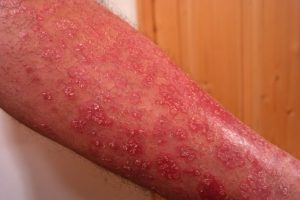 Psoriasis er en hud lidelse 